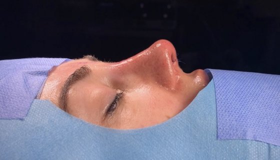 DOĞAL BURUN ESTETİĞİ